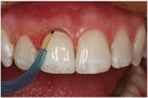 Lasers Dentistry in USA