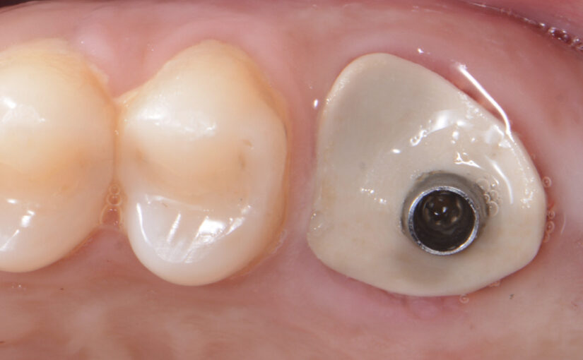 Sealing Socket Abutment